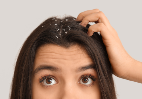 Dandruff