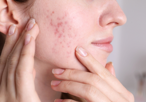 Acne Scar Treatment in Noida