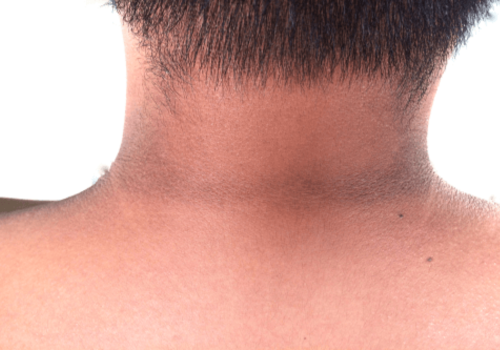 Pseudo Acanthosis Nigricans